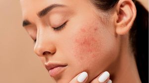 جوش و آکنه صورت چیست و چگونه رفع میگردد؟ جوش و آکنه صورت چیست و چگونه رفع میگردد؟
