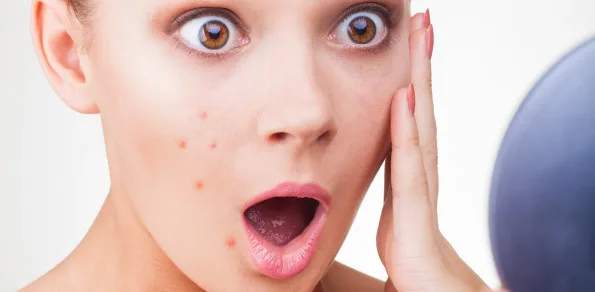 جوش و آکنه صورت چیست و چگونه رفع می‌گردد؟